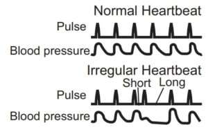 Irregular Heartbeat